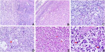 Primary renal malignant epithelioid angiomyolipoma with distant metastasis: a case report and literature review